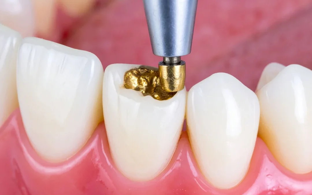 Do Dental Fillings Hurt and Should You Be Worried About Pain?
