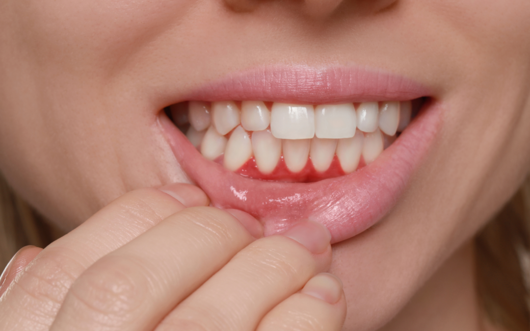 Early Signs of Gum Disease: What to Look For & How to Treat It