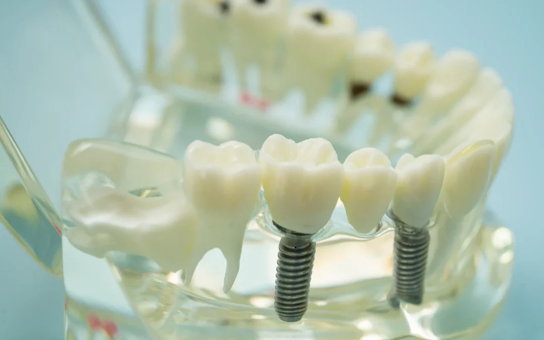 Multiple Tooth Implants vs Full Mouth Implants