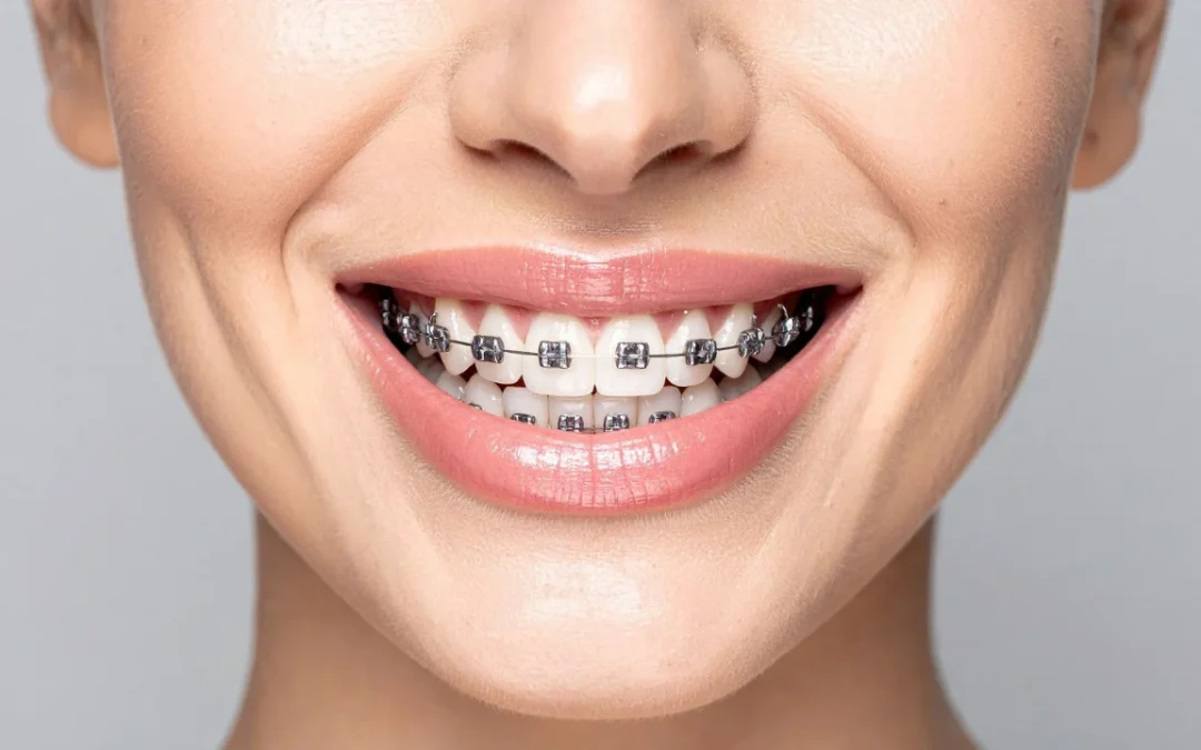 braces for overcrowded teeth