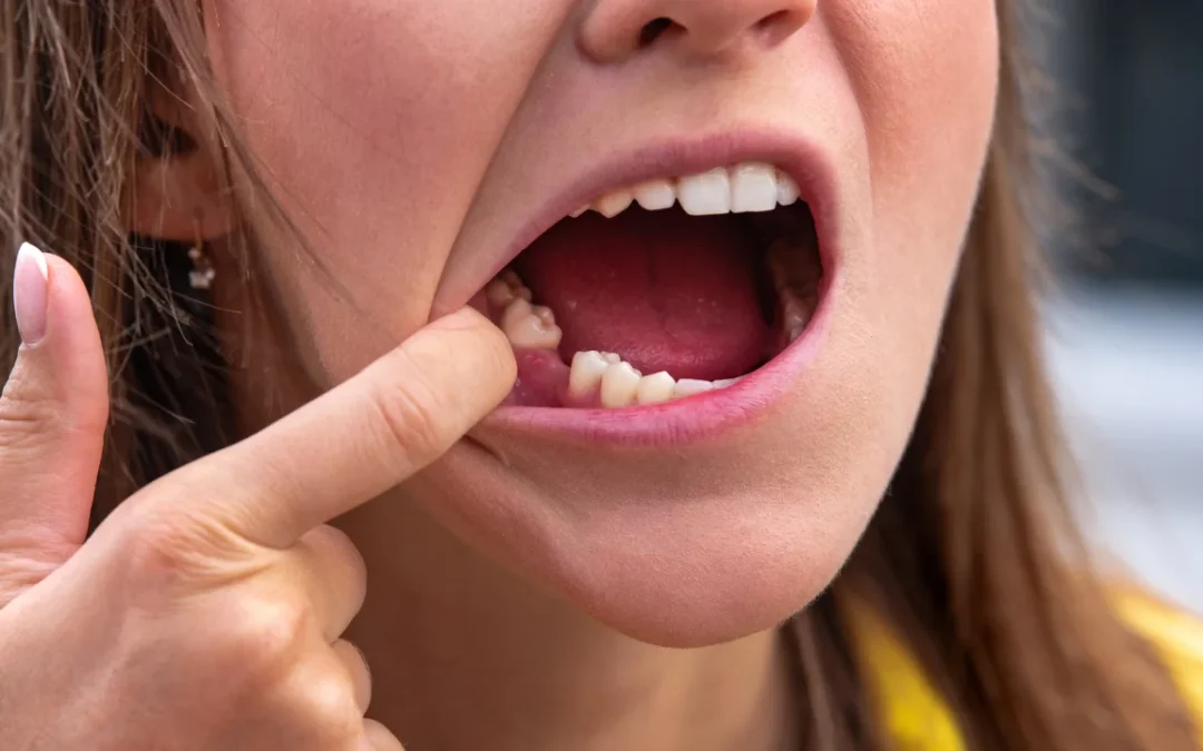 Dry Socket Symptoms After Tooth Extraction