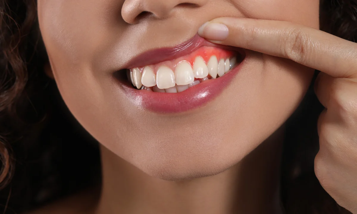 gum recession and sensitive teeth
