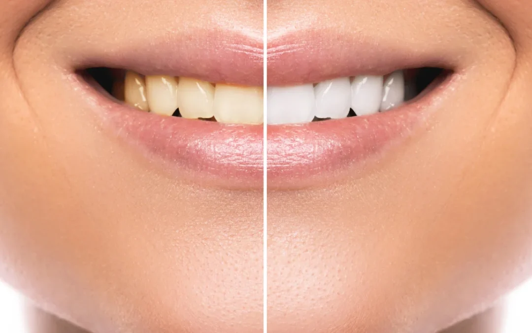 professional vs diy teeth whitening