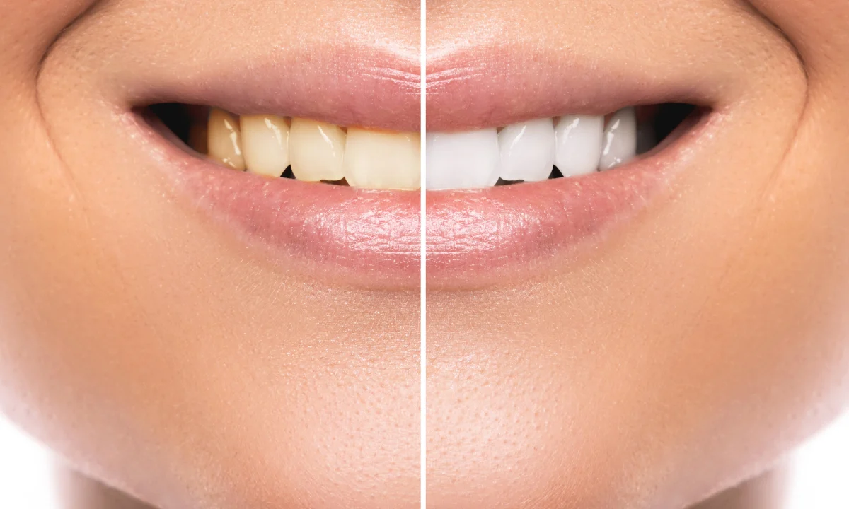professional vs diy teeth whitening
