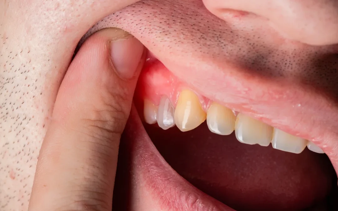 Can Gingivitis Be Reversed in a Week