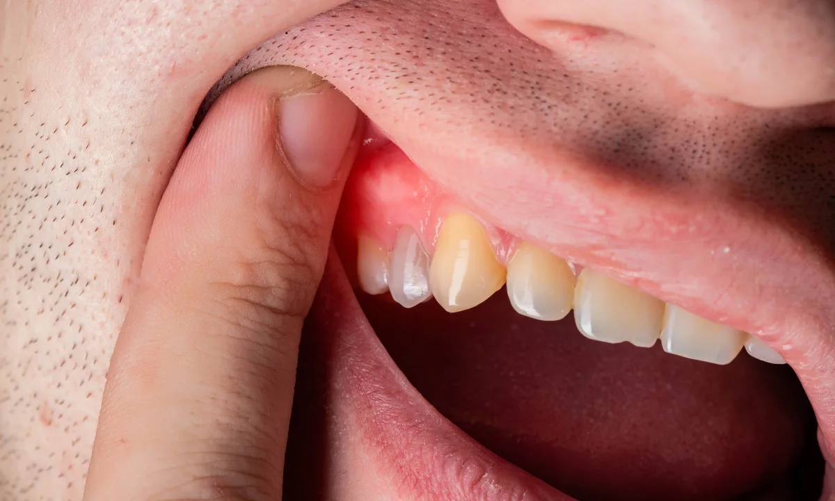 Can Gingivitis Be Reversed in a Week