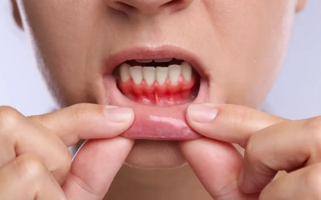 Pregnancy Gingivitis