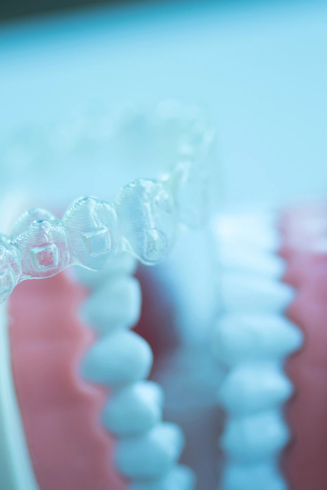 Close-up of a clear aligner tray positioned over a dental model. Discreet teeth straightening at St Leonards Green Dental.