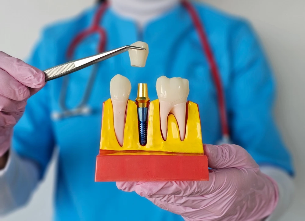 Dental Implants (3) Hands holding a tooth implant model. Tweezers place a crown. Expert dental implant solutions at St Leonards Green Dental.