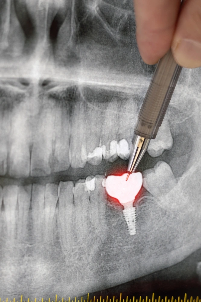 Dental Implants (4) Hand with pen points to a digital X-ray showing a complex dental implant case. Precise diagnostics at St Leonards Green Dental.