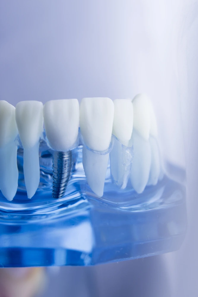 Dental Implants Close-up of a clear blue dental model showcasing a single tooth implant screw and crown. Visit St Leonards Green Dental.