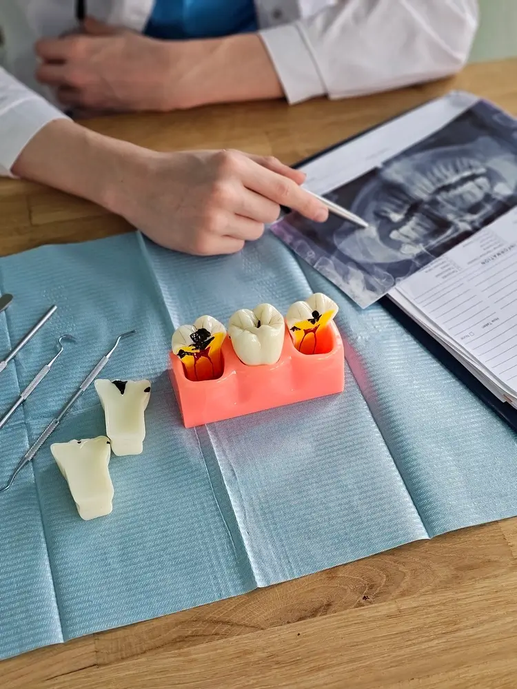 Detailed tooth decay models and dental X-rays used for root canal consultations at St Leonards Green Dental.
